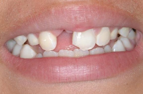 TJ reforma sentena em que mulher seria indenizada por perda de quatro dentes